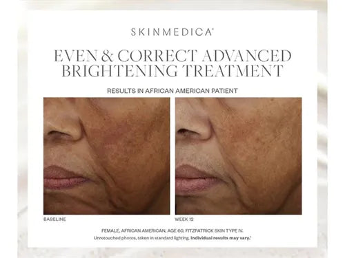 SkinMedica Even & Correct Advanced Brightening Serum